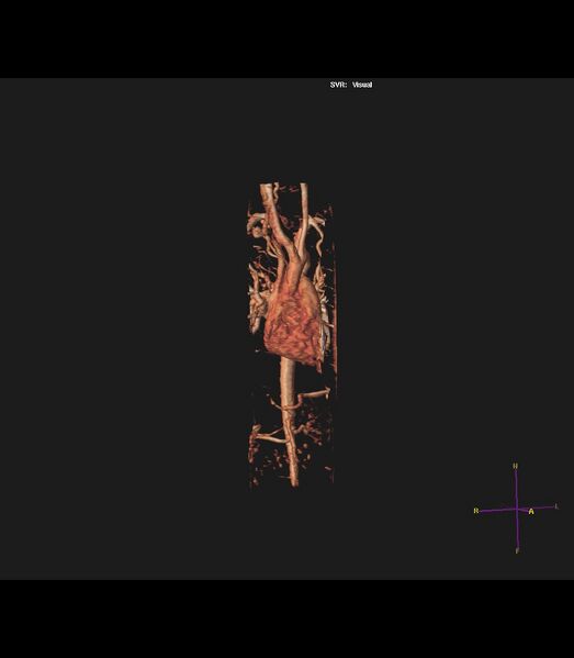 File:Coarctation of the aorta (Radiopaedia 43373-46729 3D reconstruction 26).jpg