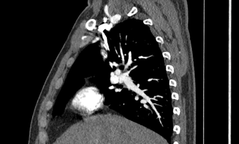 File:Coarctation of the aorta (Radiopaedia 53363-59343 B 14).jpg