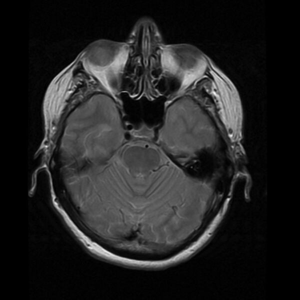 File:Colloid cyst with hydrocephalus (Radiopaedia 9373-10065 Axial PD 6).jpg