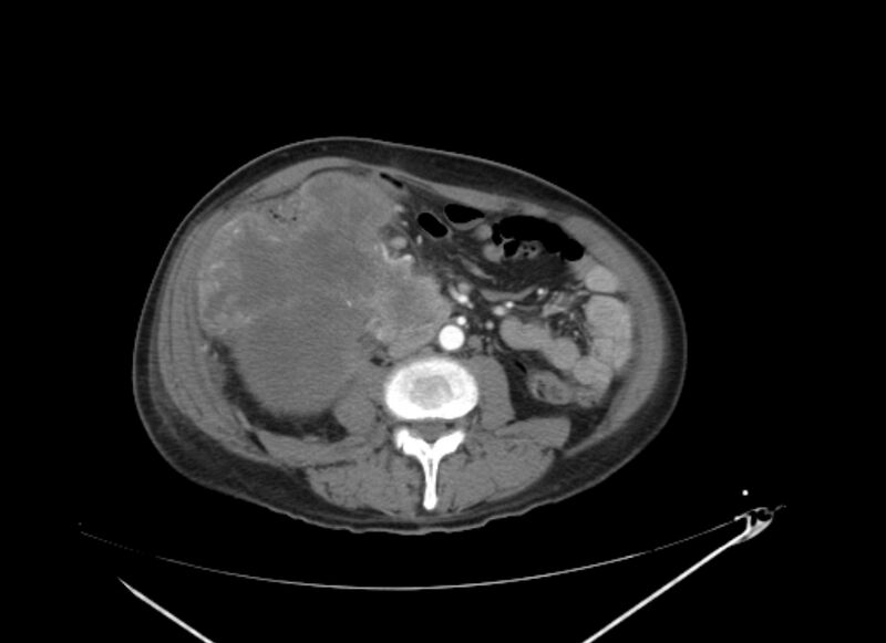 File:Colon cancer mimicking renal cell carcinoma (Radiopaedia 28986-29335 B 42).jpg