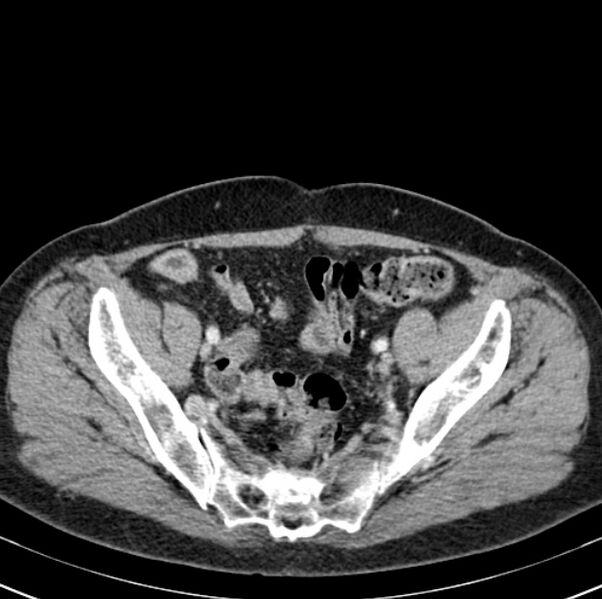 File:Colon carcinoma with hepatic metastases (Radiopaedia 29477-29961 A 94).jpg