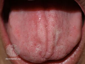 Contact stomatitis (DermNet NZ site-age-specific-stomatitis1).jpg