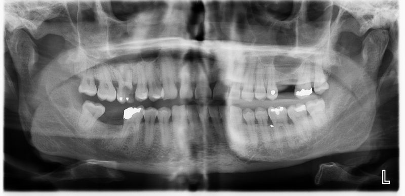 File:Dental infection (Radiopaedia 40182).png