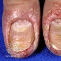 Eczema (DermNet NZ fungal-paron6).jpg