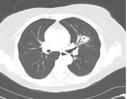 Chest computed tomography image showing left upper lobe cavitary lesion consistent with invasive pulmonary aspergillosis