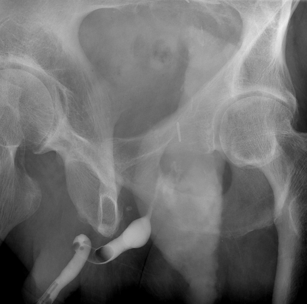 File:Iatrogenic urethral injury (Radiopaedia 31333).png