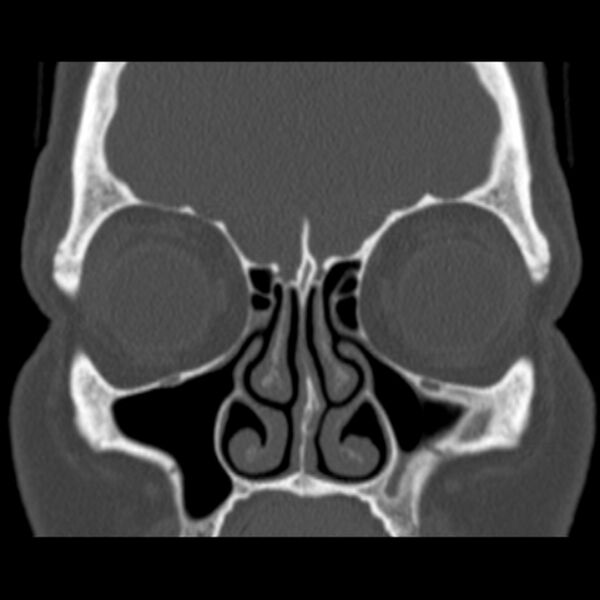 File:Nasolabial cyst (Radiopaedia 33987-35205 Coronal bone window 32).jpg