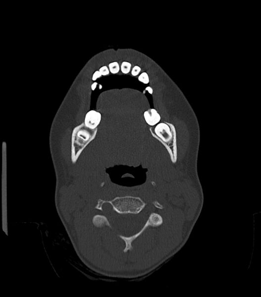 File:Nasoorbitoethmoid fracture (Radiopaedia 90044-107205 Axial bone window 36).jpg