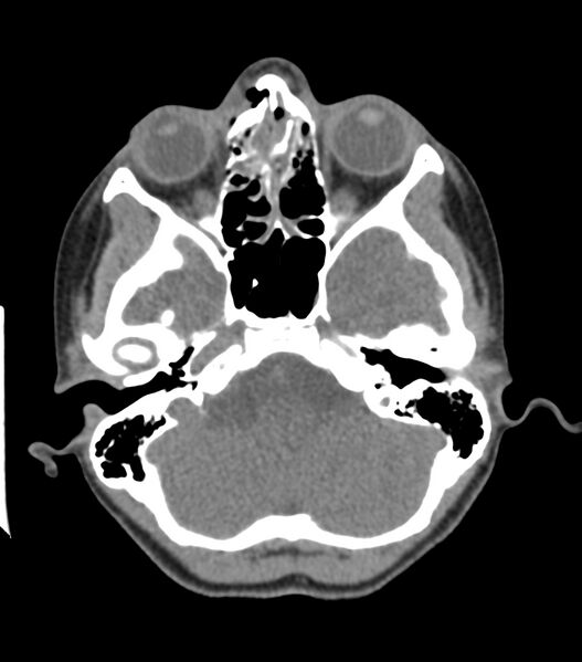 File:Nasoorbitoethmoid fracture (Radiopaedia 90044-107205 Axial non-contrast 152).jpg