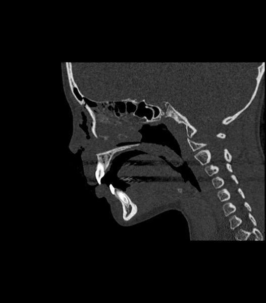 File:Nasoorbitoethmoid fracture (Radiopaedia 90044-107205 Sagittal bone window 82).jpg