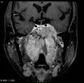Nasopharyngeal carcinoma (Radiopaedia 4546-6667 E 8).jpg