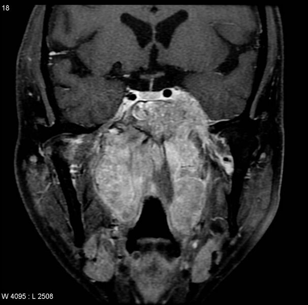 File:Nasopharyngeal carcinoma (Radiopaedia 4546-6667 E 8).jpg