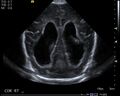 Neonatal intracranial hemorrhage - grade 3 (Radiopaedia 27279-27455 A 8).jpg