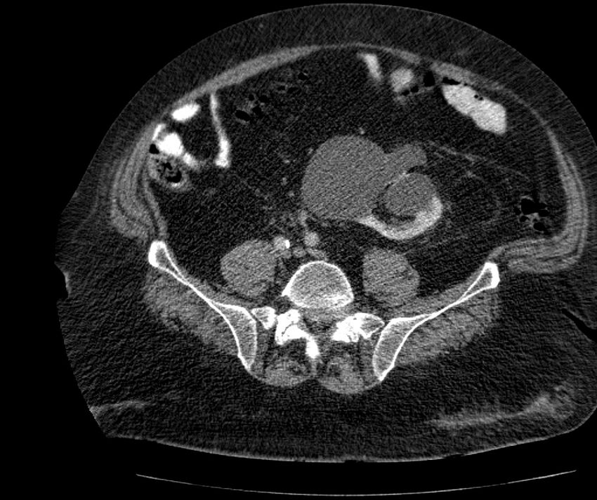 Nephroptosis with inguinal hernia containing perirenal fat (Radiopaedia 56632-63391 C 240).jpg