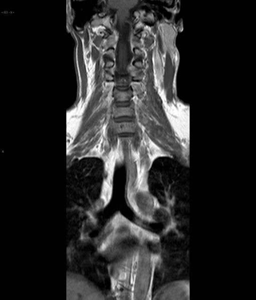 File:Neurofibromatosis type 1 (Radiopaedia 36933-38560 Coronal T1 9).jpg