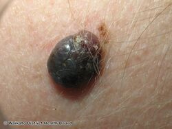 Nodular melanoma (DermNet NZ nm-10).jpg