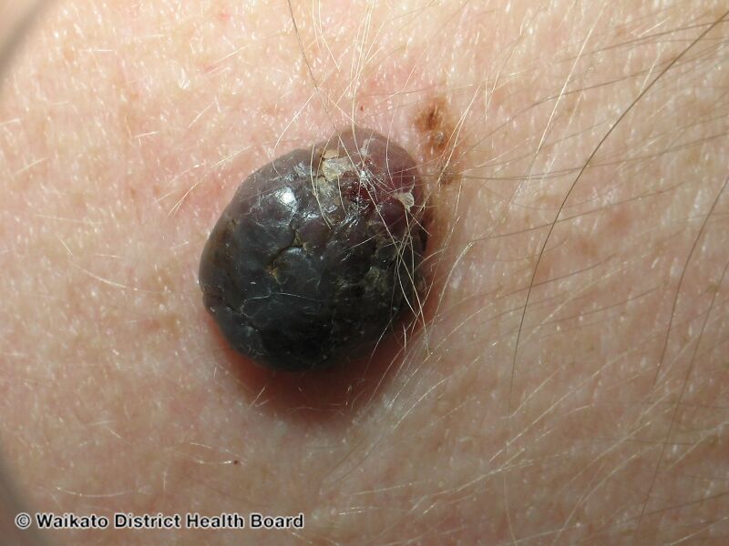 File:Nodular melanoma (DermNet NZ nm-10).jpg