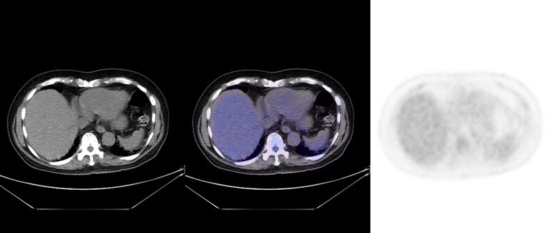 File:Non-Hodgkin lymphoma involving seminal vesicles with development of interstitial pneumonitis during Rituximab therapy (Radiopaedia 32703-33752 ax CT Fus PET 29).jpg