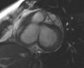 Non-compaction of the left ventricle (Radiopaedia 69436-79314 Short axis cine 167).jpg