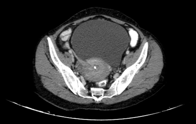 File:Non-puerperal uterine inversion (Radiopaedia 78343-91094 A 8).jpg