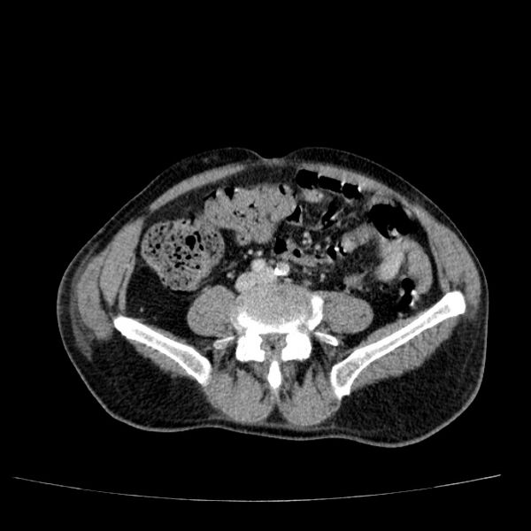 File:Non small-cell lung cancer (Radiopaedia 24467-24769 C+ delayed 89).jpg