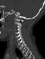 Normal CT cervical spine - pediatric (Radiopaedia 52549-58462 Sagittal bone window 49).jpg