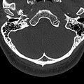 Normal CT of the cervical spine (Radiopaedia 53322-59305 Axial bone window 21).jpg