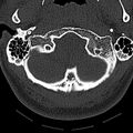 Normal CT of the cervical spine (Radiopaedia 53322-59305 Axial bone window 35).jpg