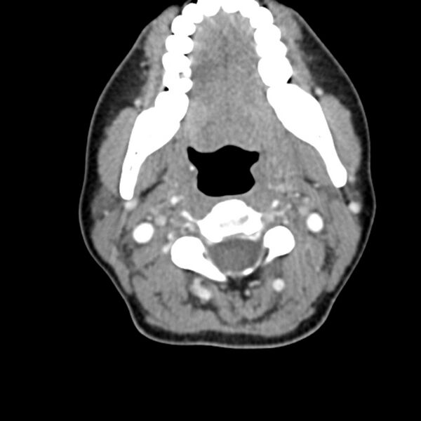 File:Normal CT of the neck (Radiopaedia 14575-14500 Axial C+ 29).jpg