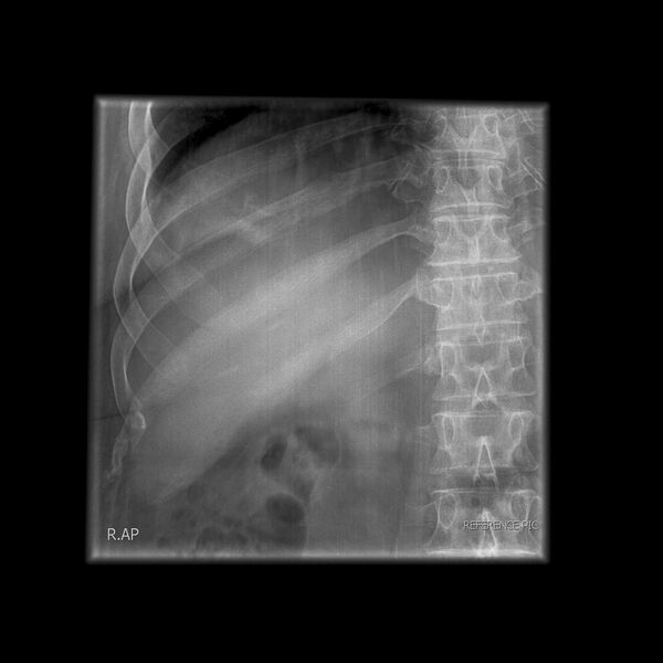 File:Normal T-tube cholangiography (Radiopaedia 67244-76601 A 1).JPEG