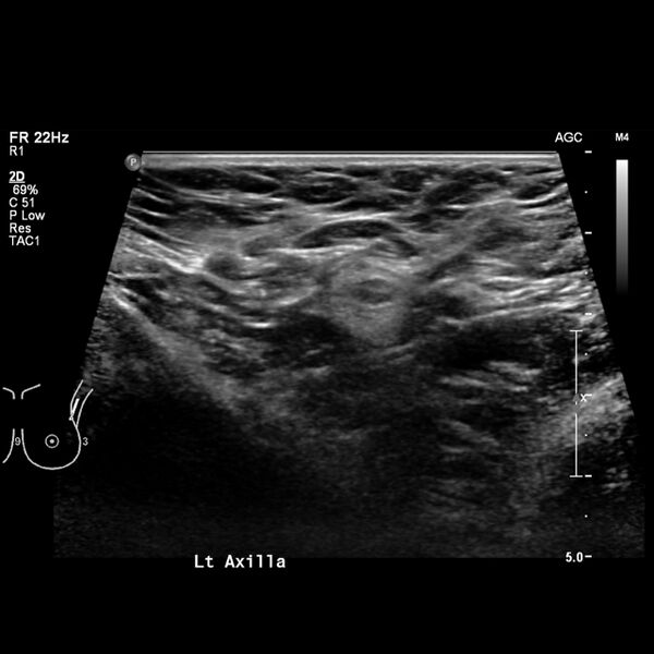 File:Normal breast mammography (tomosynthesis) and ultrasound (Radiopaedia 65325-74354 Left breast 18).jpeg
