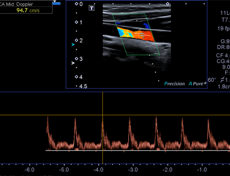File:Normal carotid Doppler ultrasound (Radiopaedia 54495).png