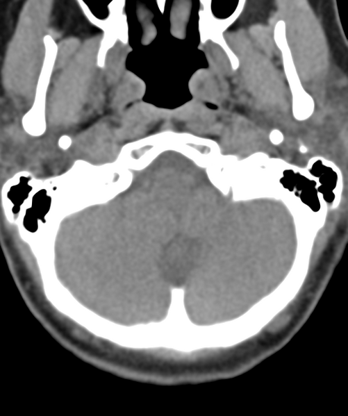 File:Normal cervical spine MRI (including Dixon) (Radiopaedia 42762-45926 Axial non-contrast 6).png