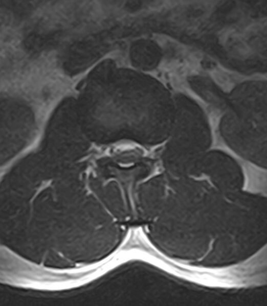 File:Normal lumbar spine MRI - low-field MRI scanner (Radiopaedia 40976-43699 Axial T2 31).jpg