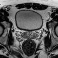 Normal prostate (MRI) (Radiopaedia 29986-30535 Axial T2 16).jpg