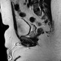Normal prostate (MRI) (Radiopaedia 29986-30535 Sagittal T2 15).jpg
