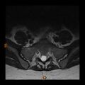 Normal spine MRI (Radiopaedia 77323-89408 Axial T2 27).jpg