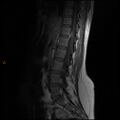 Normal spine MRI (Radiopaedia 77323-89408 Sagittal T1 6).jpg