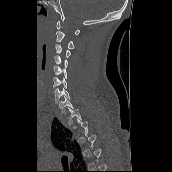 File:Normal trauma spine imaging (Radiopaedia 31753-32686 Sagittal bone window 14).jpg