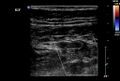Normal vermiform appendix (Radiopaedia 9553-40788 A 4).jpg