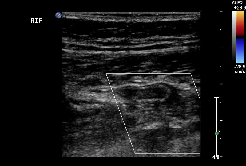 File:Normal vermiform appendix (Radiopaedia 9553-40788 A 4).jpg