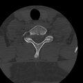 Occipital condyle fracture (Radiopaedia 31755-32691 Axial bone window 68).jpg