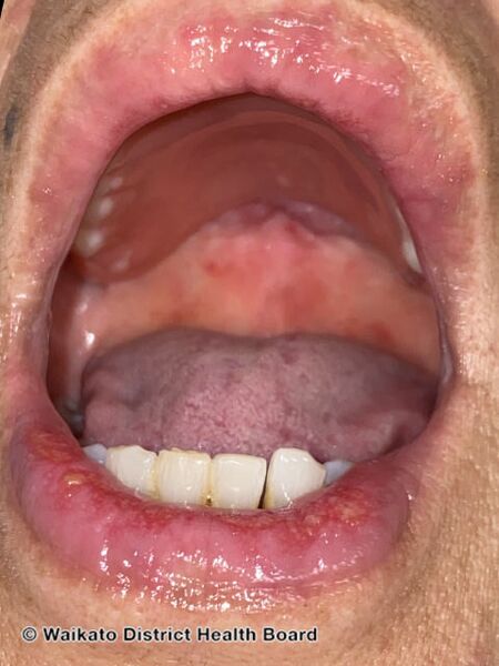 File:Oral lesions in AGEP (DermNet NZ AGEP-mouth).jpg