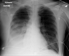 Chest X-ray pneumonia