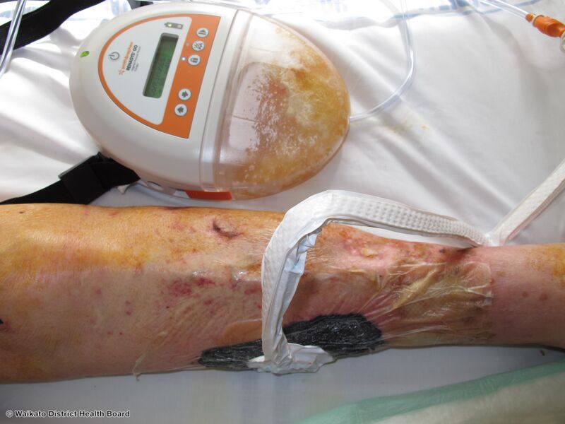 File:Wound undergoing treatment with negative-pressure device (DermNet NZ vac-wound-2).jpg