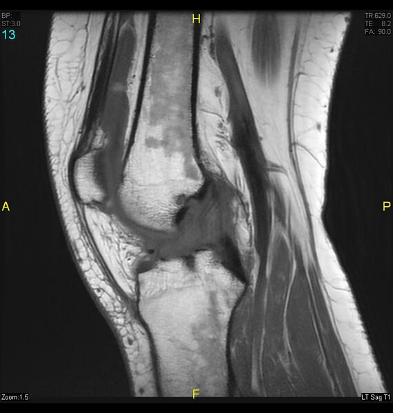 File:ACL mucoid degeration with cystic changes (Radiopaedia 48428-53341 Sagittal T1 11).jpg