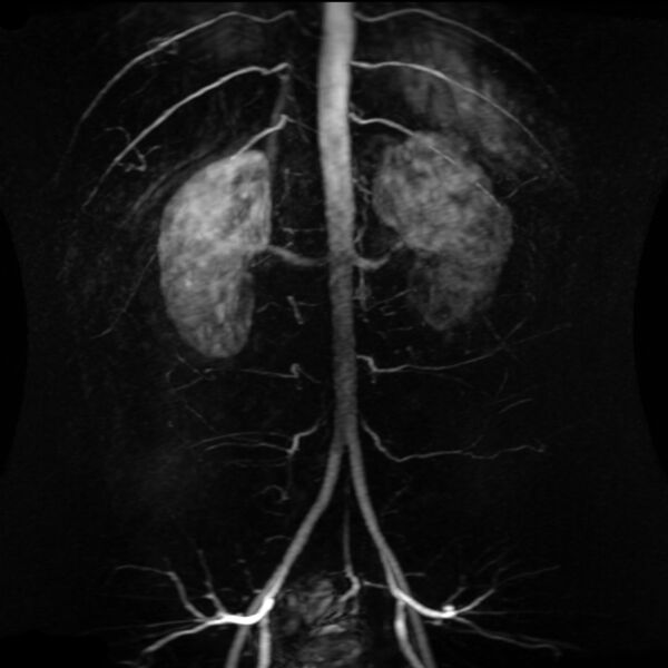 File:Abdominal aorta- normal MRA (Radiopaedia 36394).jpg