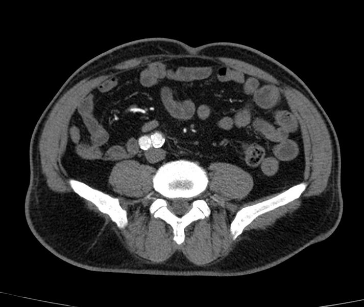 File:Abdominal aortic aneurysm (Radiopaedia 22421-22458 C+ arterial phase 59).jpg
