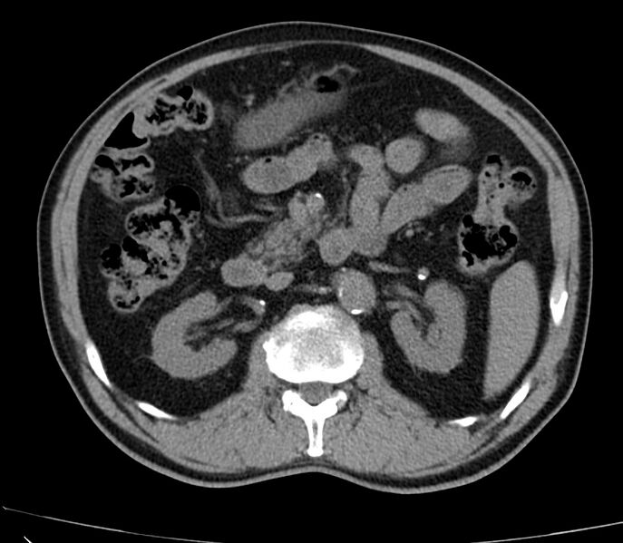 File:Abdominal aortic aneurysm (Radiopaedia 22421-22458 non-contrast 21).jpg