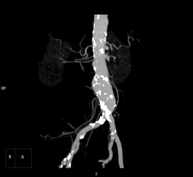 File:Abdominal aortic aneurysm (Radiopaedia 23703-23856 MIP 3).jpg